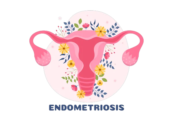Endometriosis infographic, GPAtlas Scope